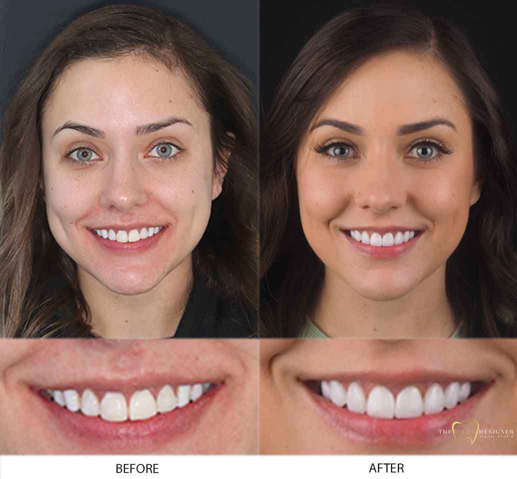 Before & After Tooth Transformation & Treatment melbourne