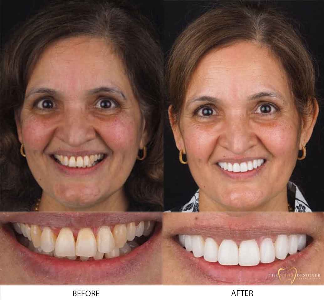 Jasvir's Photo of Before and After Dental Treatment