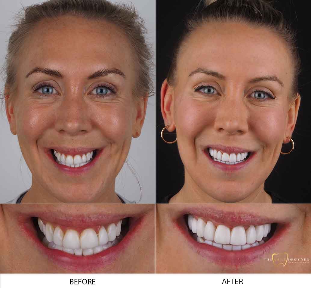 Kate's Photo of Before and After Dental Treatment