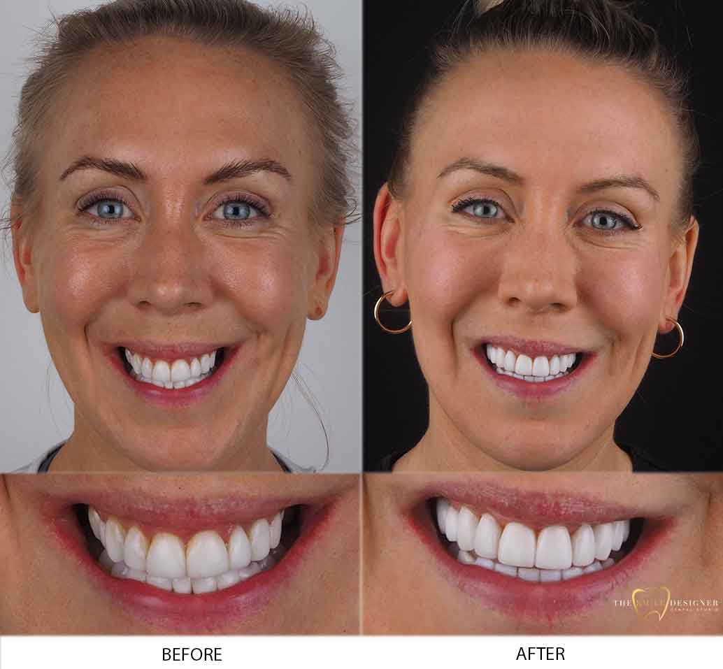 What is cosmetic dentistry?  Smile Makeover Northcote VIC