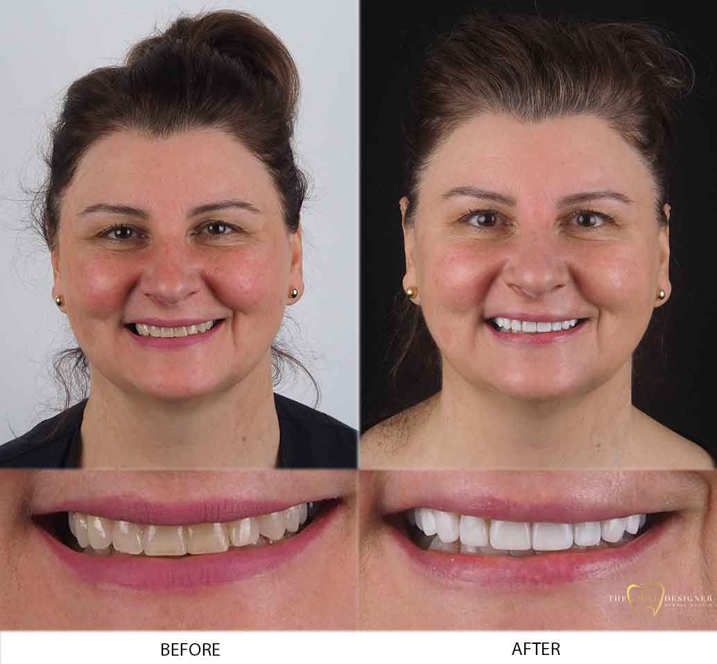 Lina's Photo of Before and After Dental Treatment
