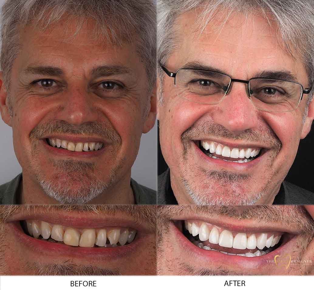 Michael's Photo of Before and After Dental Treatment