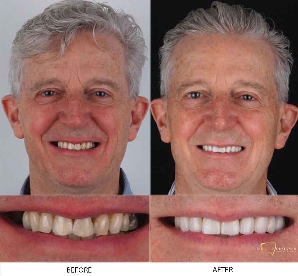 Paul's Photo of Before and After Dental Treatment