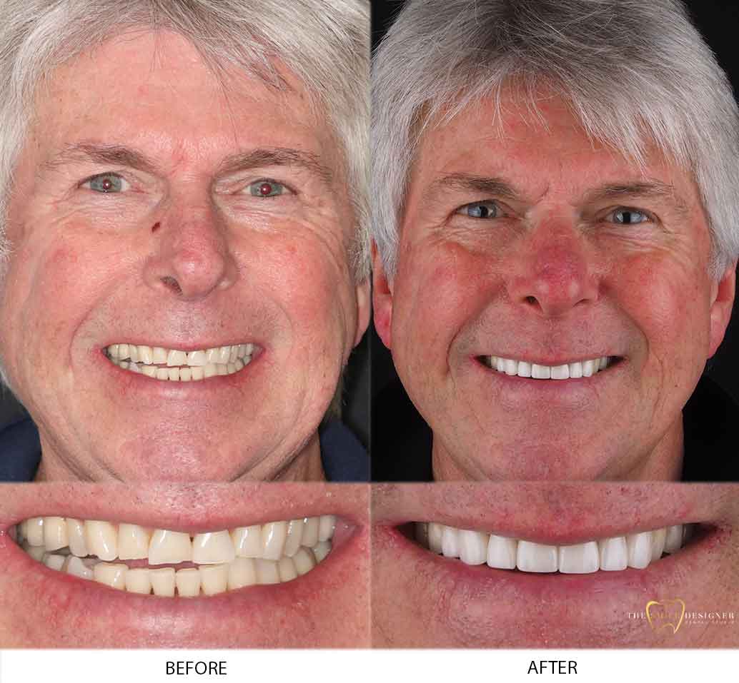 Peter's Photo of Before and After Dental Treatment