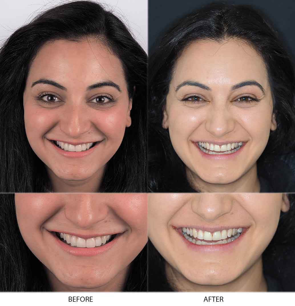 Somer's Photo of Before and After Composite Dental Treatment