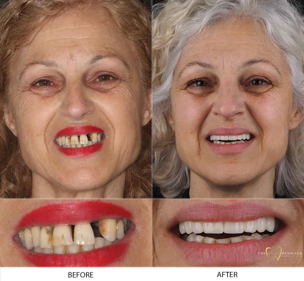 Anna's Photo of Before and After Dental Implants Treatment