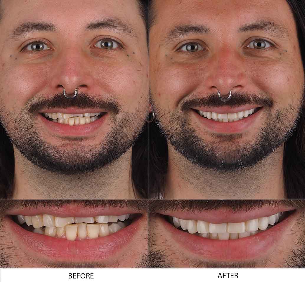 Danny's Photo of Before and After Composite Dental Treatment