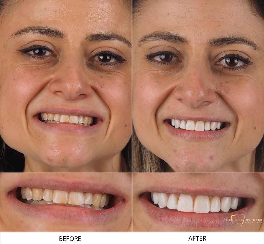 Rita's Photo of Before and After Composite Dental Treatment