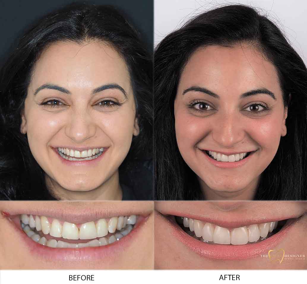 Before and after dental treatment