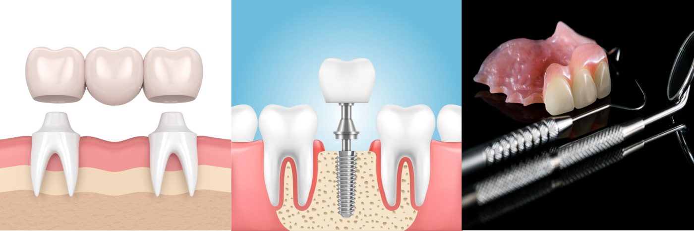 Dental-Implants-Vs.-Bridges-Vs.-Dentures