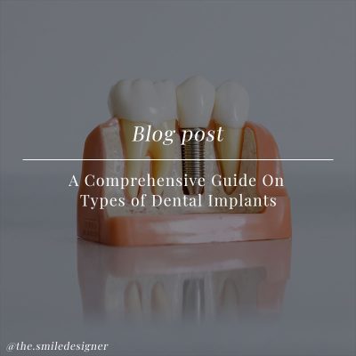 A Comprehensive Guide On Types of Dental Implants